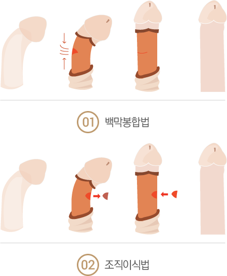 ���游������ ġ��(�������)